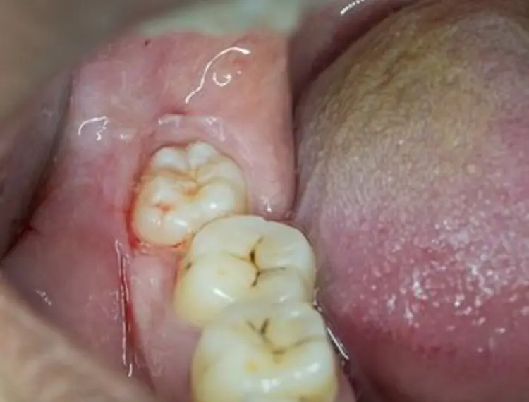 Wisdom teeth