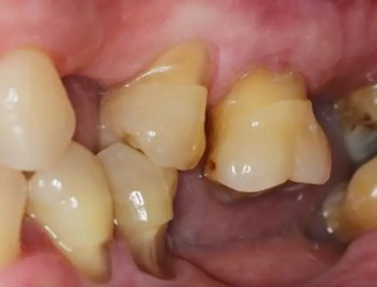 Non-carious cervical lesions