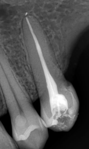 Root canal