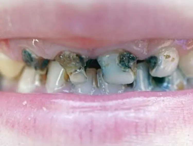 Tooth decay