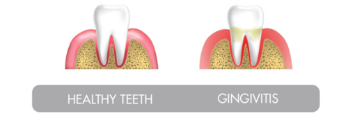 healthy-teeth-perio-1.png