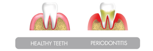 healthy-teeth-perio.png