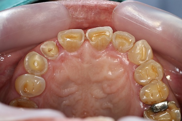 Tooth erosion