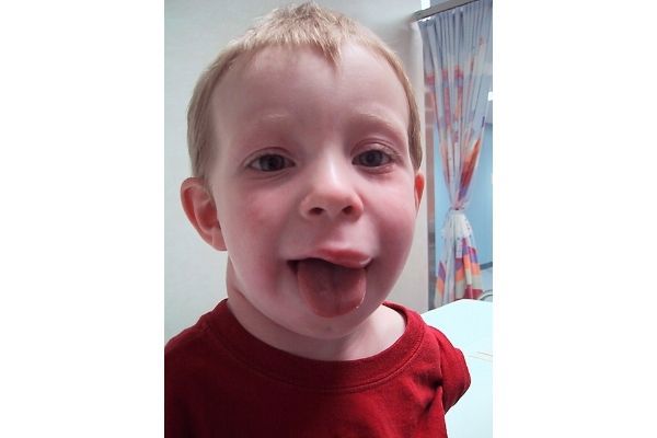 Example of Anaphlaxis