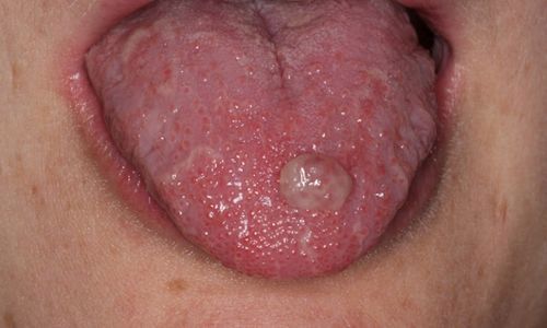 A pregnancy tumour on the top surface of the tongue.