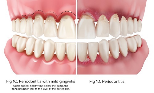 Fig-1C GingPeri