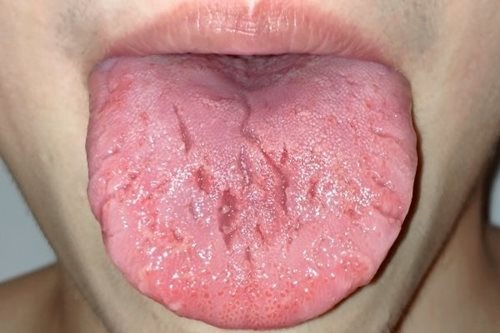 Fissured tongue