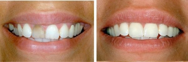 Teeth comparison image