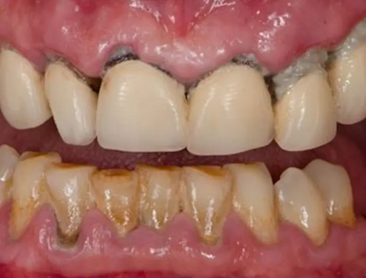 Gum disease