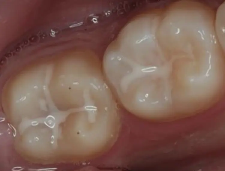 Fissure sealants