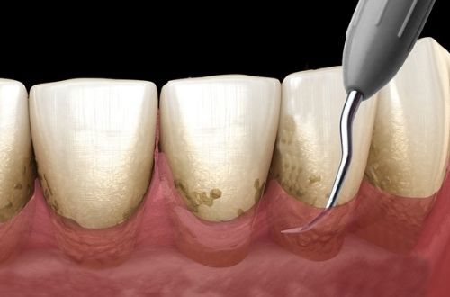 Removing plaque