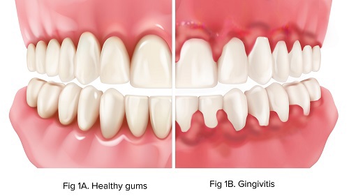 Gums