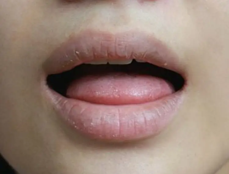 Dry mouth