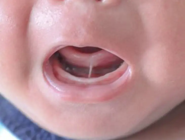 Tongue tie