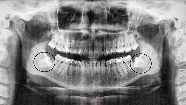 Impacted lower wisdom teeth highlighted by the black circles