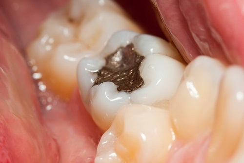 What are fillings sales made of
