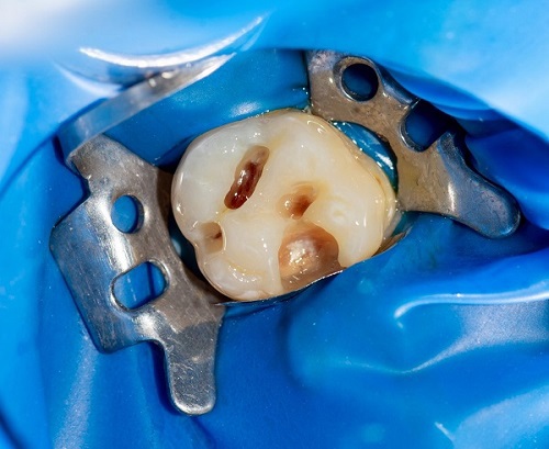 Single Isolated Tooth